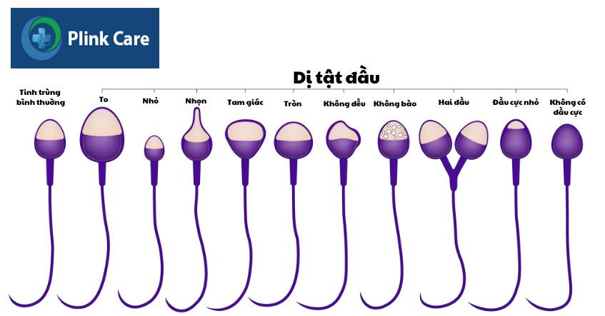 dị tật đầu tinh trùng phổ biến