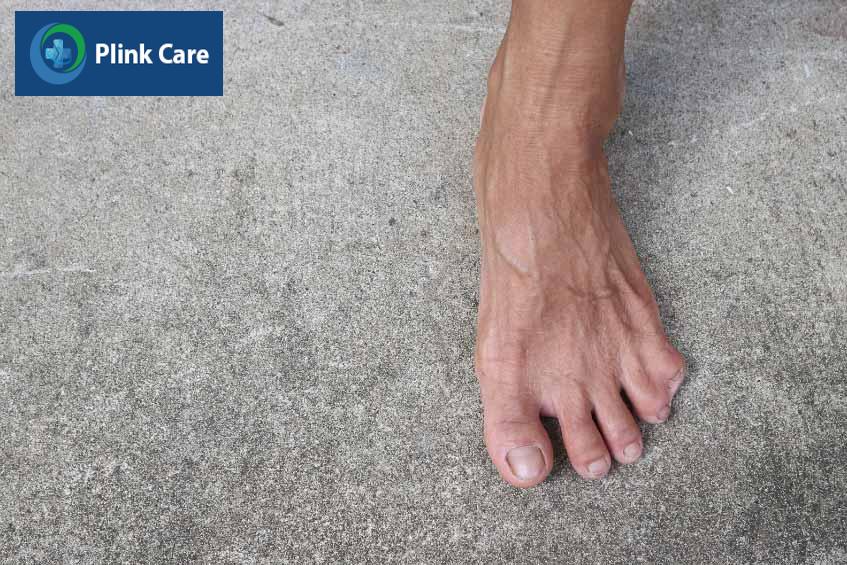dị tật gây biến dạng ở bàn chân