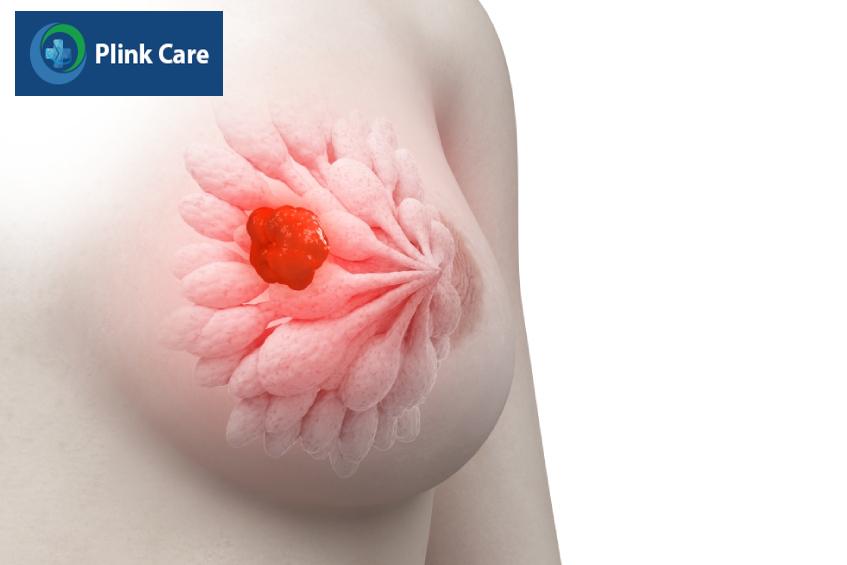 điểm tái phát vú Oncotype DX