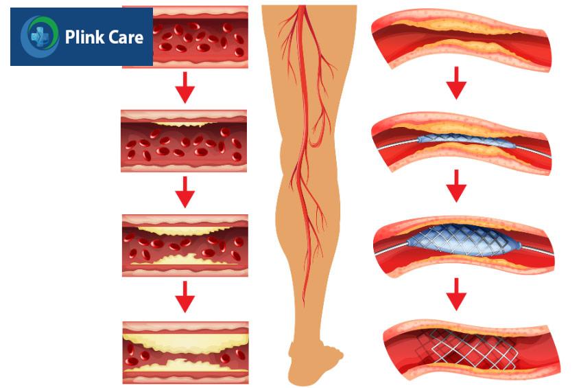 Điều trị bệnh động mạch chi dưới bằng thủ thuật nong hoặc đặt stent