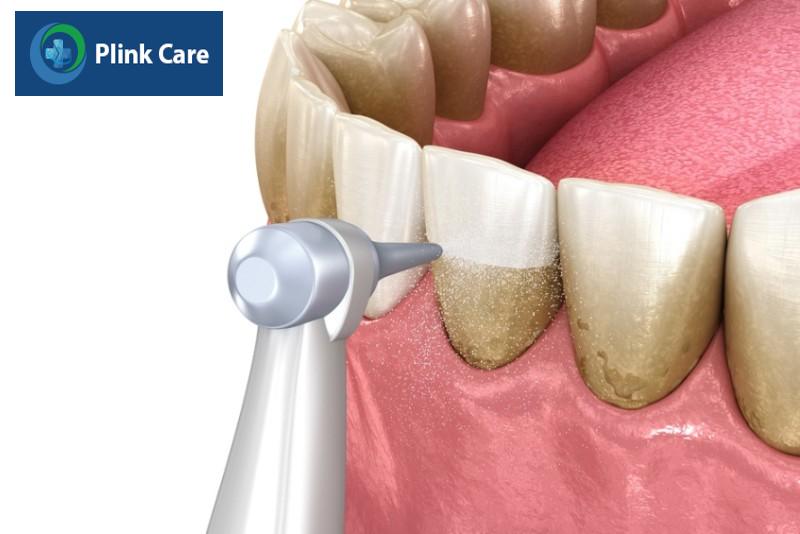 Điều trị răng lung lay bằng các điều trị viêm nướu, viêm nha chu