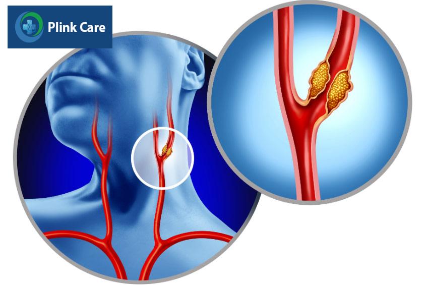 Động mạch cảnh bị tắc nghẽn do tích tụ mảng xơ vữa