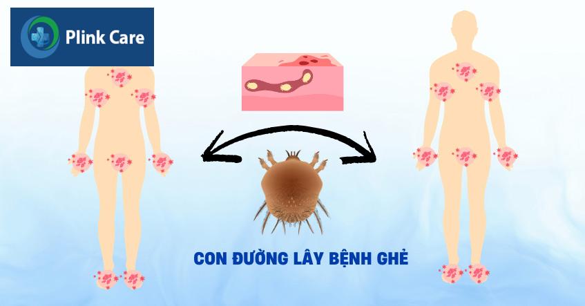 ghẻ có thể lây từ người sang người người