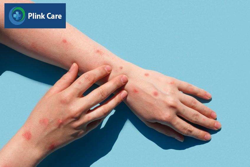 giai đoạn 1 gây sốt cao và phát ban
