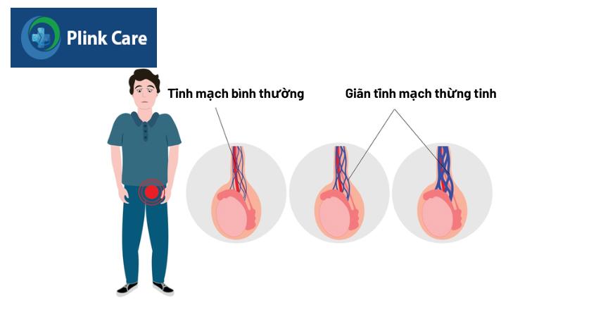 giãn tĩnh mạch thừng tinh