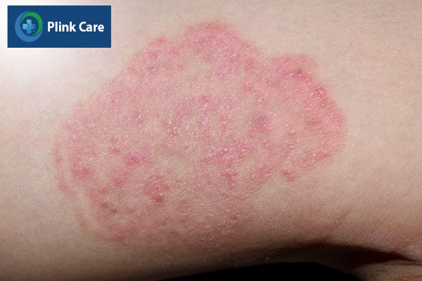 hình ảnh bệnh nấm aspergillus
