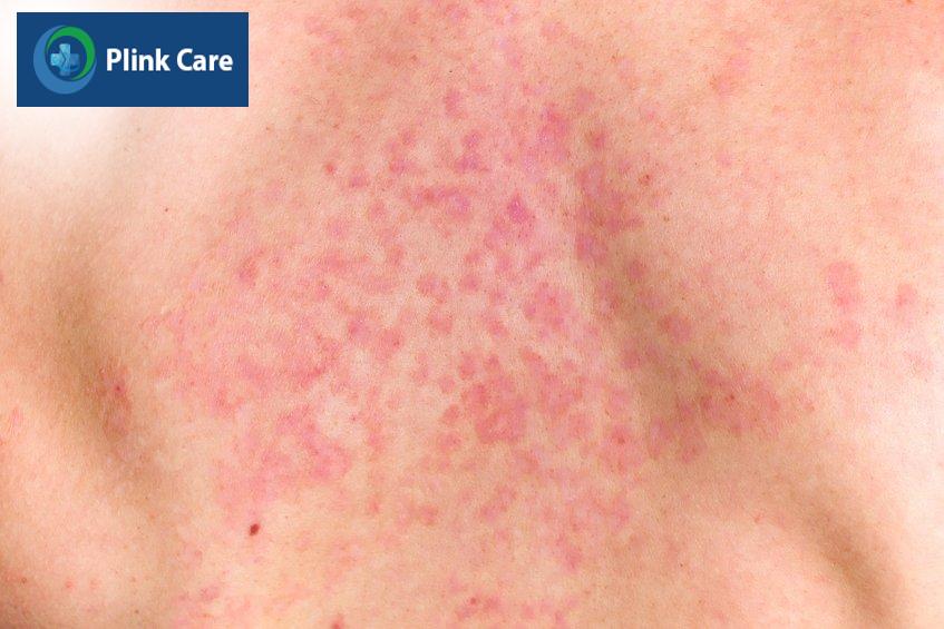 hình ảnh bệnh nấm da ở người do nấm candida