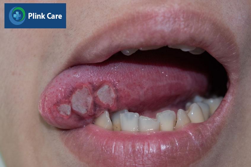hình ảnh của bệnh nhân ung thư lưỡi