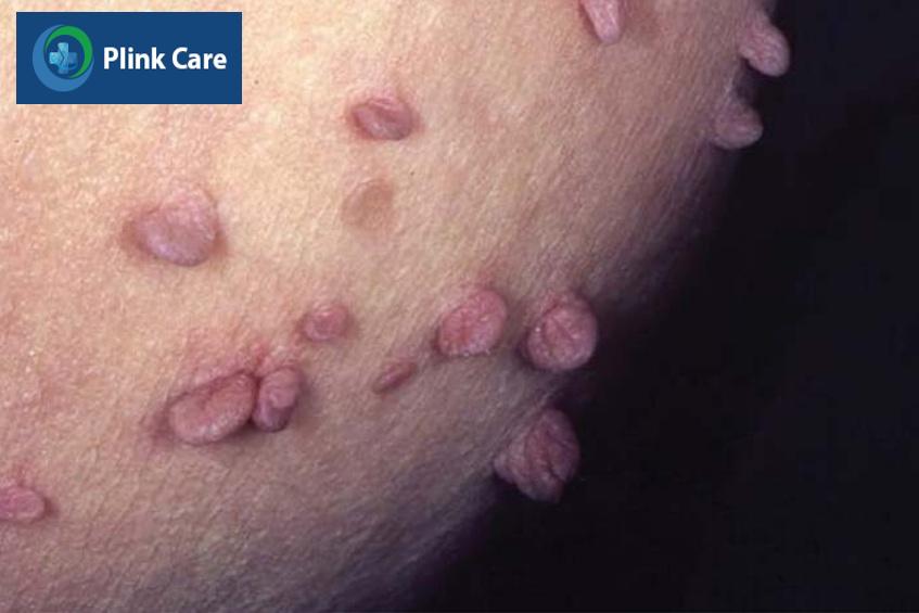 hình ảnh mụn cóc sinh dục ở nam giới do hpv