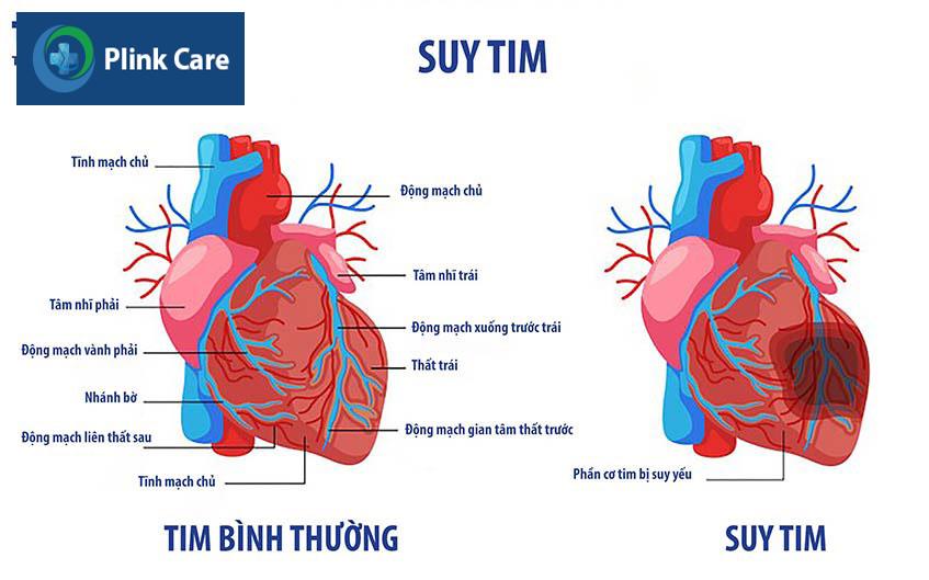 Hình ảnh tim bình thường và tim bị suy yếu (suy tim)