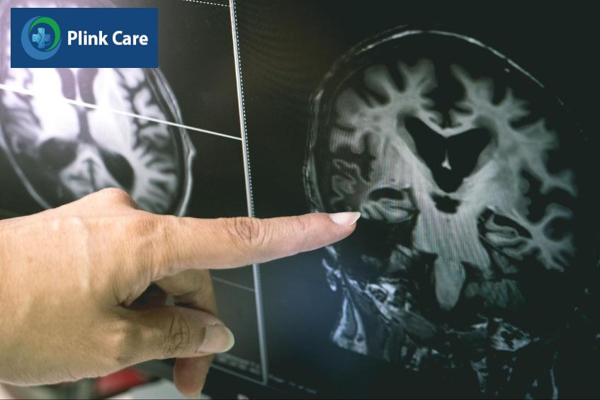 huyết áp cao có thể dẫn đến đột quỵ