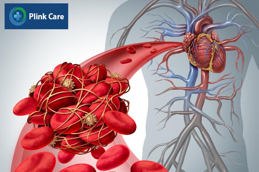 Huyết khối trong động mạch vành có thể dẫn đến nhồi máu cơ tim