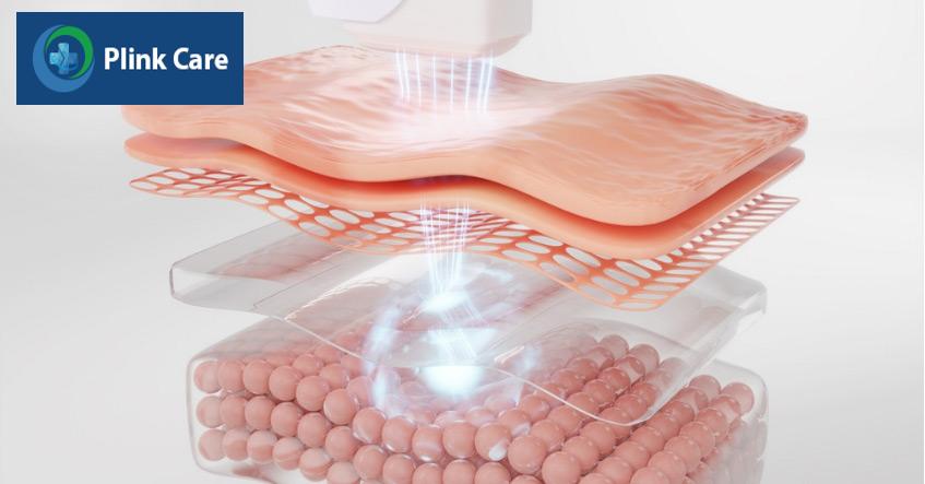 ipl tác động đến các cấu trúc sâu của da
