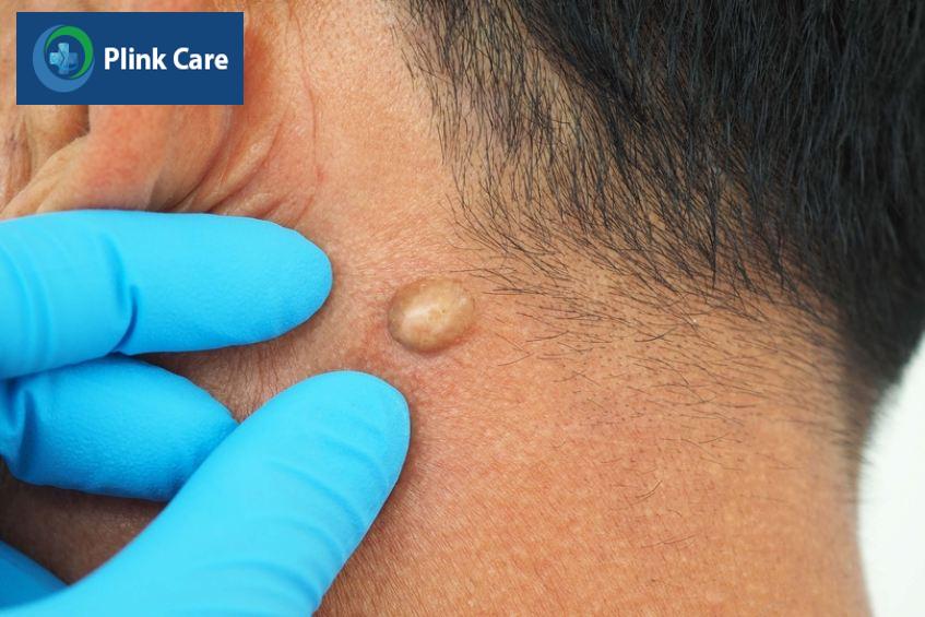 không nên tự ý điều trị u bã đậu tại nhà