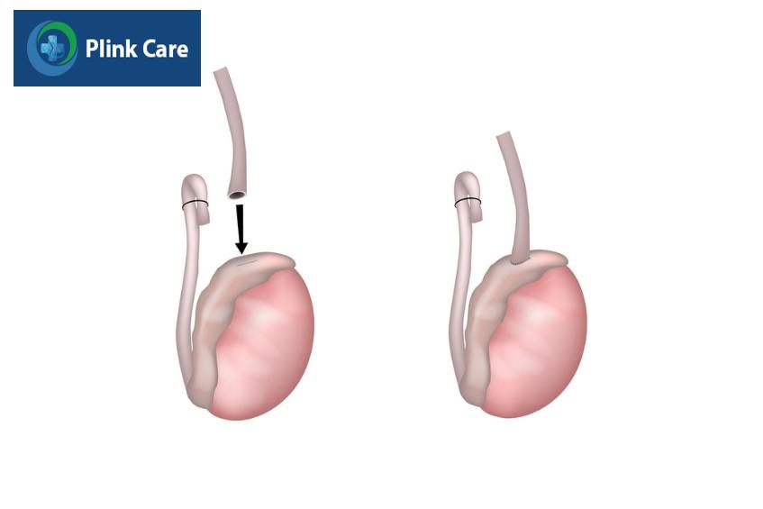 kỹ thuật vasoepididymostomy