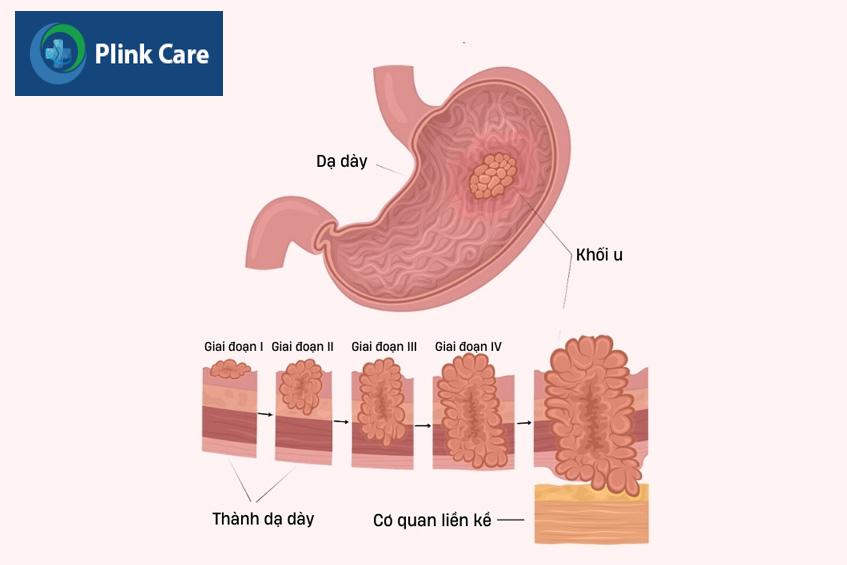 lựa chọn phương pháp điều trị