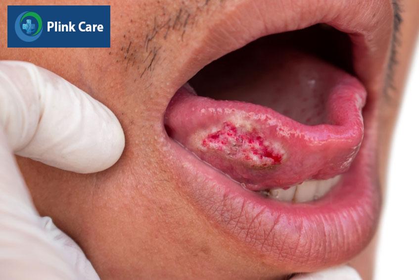 lưỡi bị ung thư giai đoạn cuối