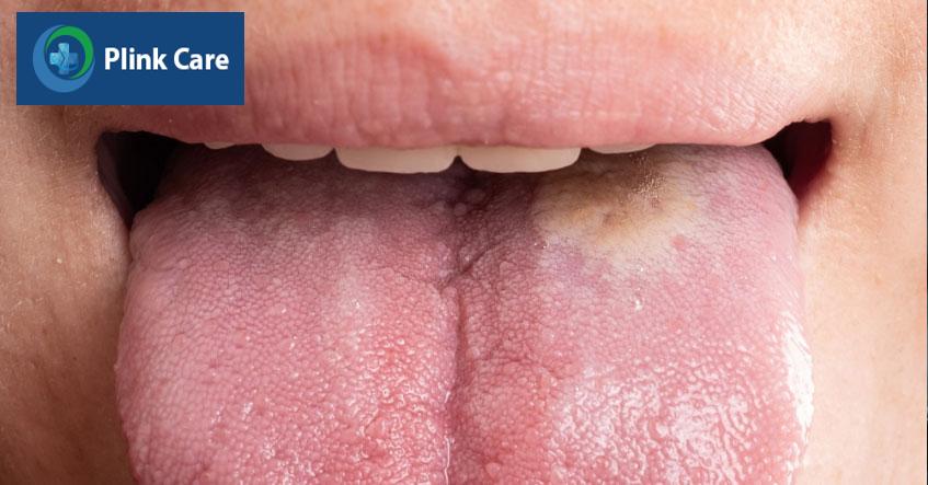 lưỡi có sự thay đổi về màu sắc