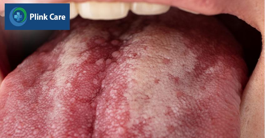 lưỡi xuất hiện tình trạng niêm mạc trắng xơ hóa