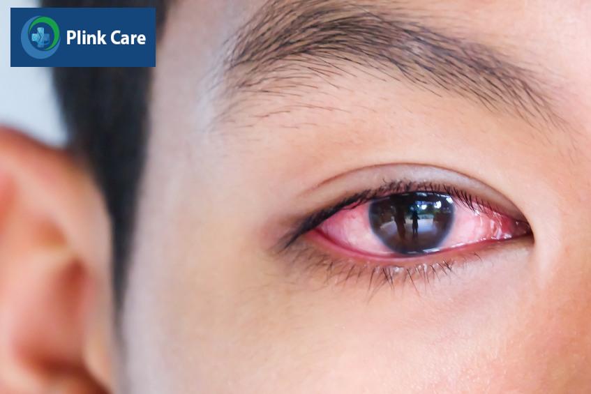 Mắt đỏ, chảy nước mắt do viêm kết mạc