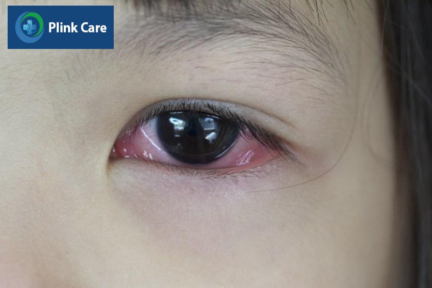 Mắt trẻ sinh đỏ, chảy nhiều dịch do viêm kết mạc