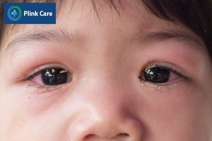 Mắt trẻ sưng đỏ, đóng nhiều vảy, ghèn do viêm kết mạc