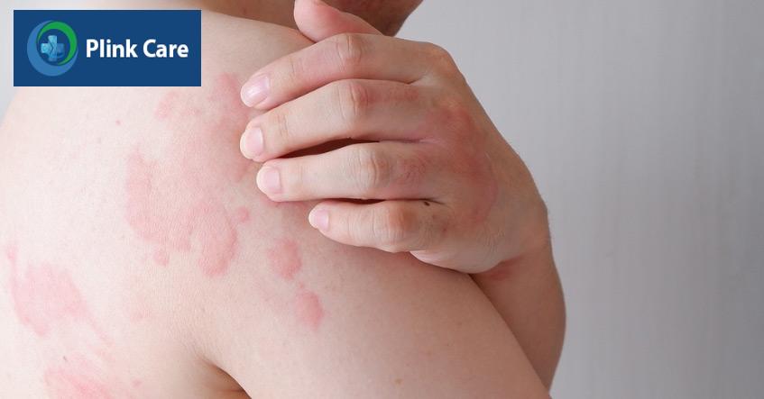 mề đay mạn tính lâu khỏi hơn và thường xuyên tái lại