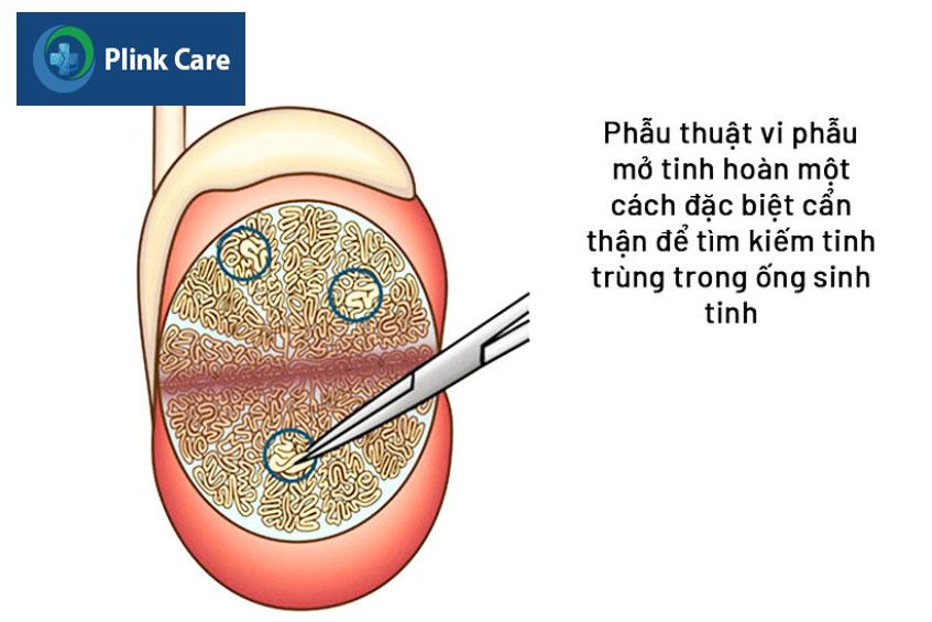 Micro-TESE giúp tìm kiếm và xác định các vùng ống sinh tinh có chứa tinh trùng