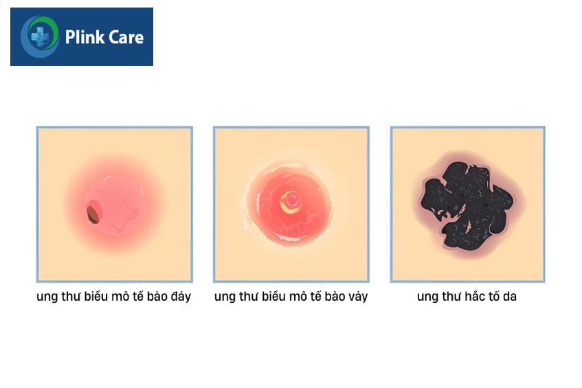 mô phỏng các loại ung thư da phổ biến