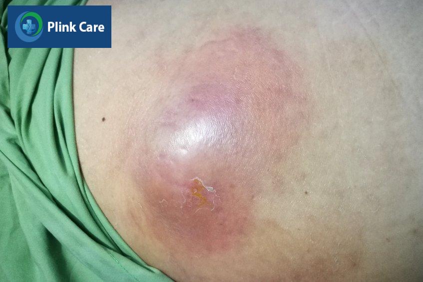 Mụn nhọt khi không được chăm sóc và điều trị đúng cách