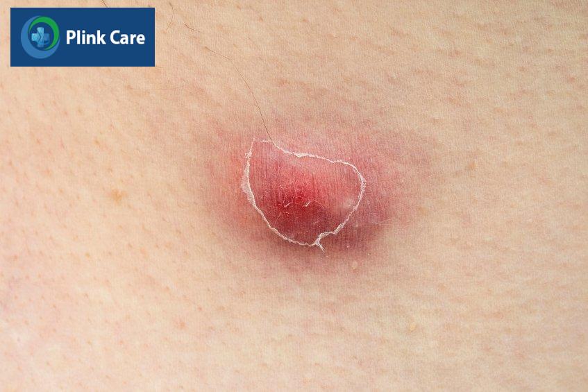 Mụn nhọt khiến da sưng, tấy đỏ, gây cảm giác đau đớn