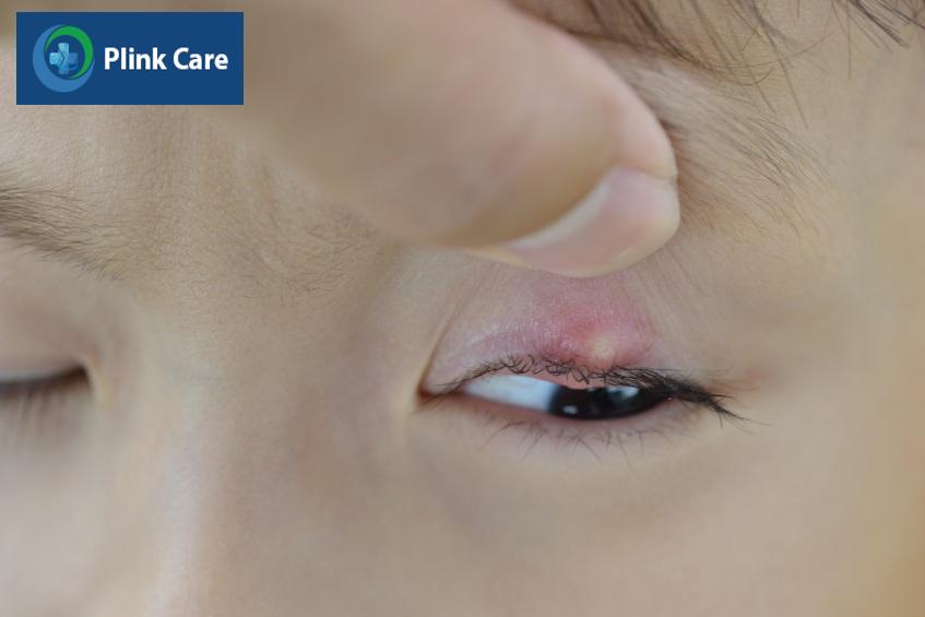 Mụn nhọt xuất hiện ở mí mắt gây khó chịu