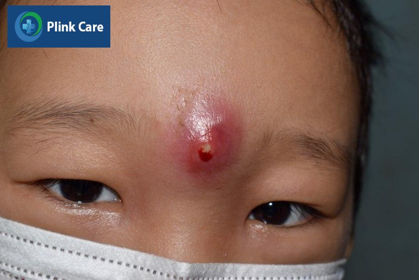 Mụn nhọt xuất hiện ở vùng mặt
