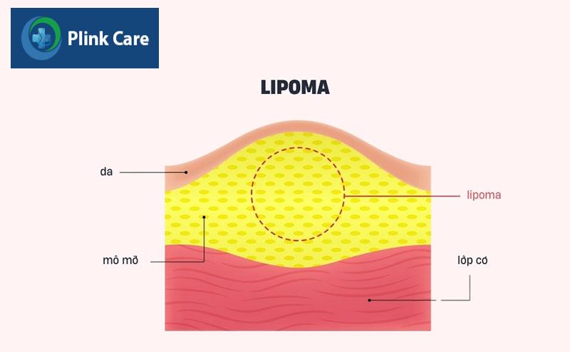 U mỡ (lipoma) hình thành do sự phát triển bất thường của các tế bào mỡ