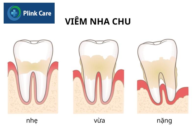 Nguyên nhân răng bị lung lay