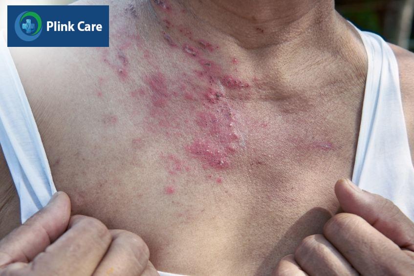 nhận biết viêm da tiếp xúc