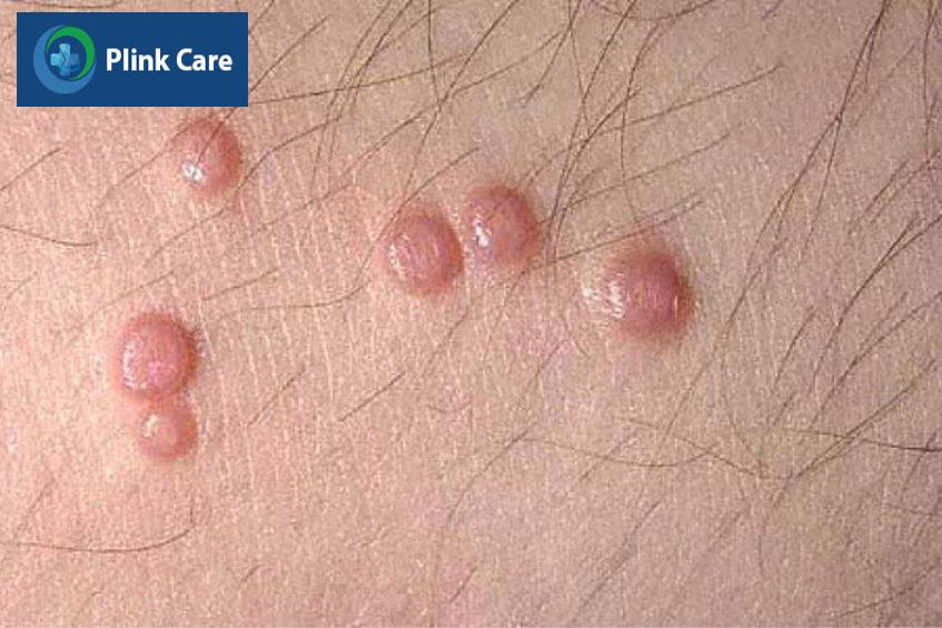 nhiễm hpv ở nam giới gây mụn cóc sinh dục