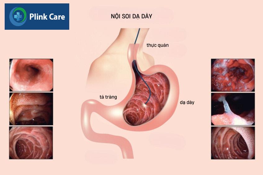nội soi dạ dày là phương pháp khám ung thư dạ dày phổ biến