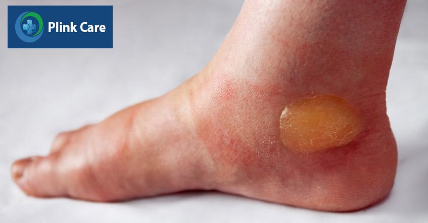 pemphigoid gây bọng nước ở lớp dưới thượng bì