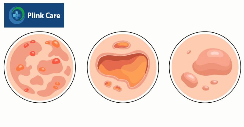pemphigus là nhóm bệnh rối loạn tự miễn dịch
