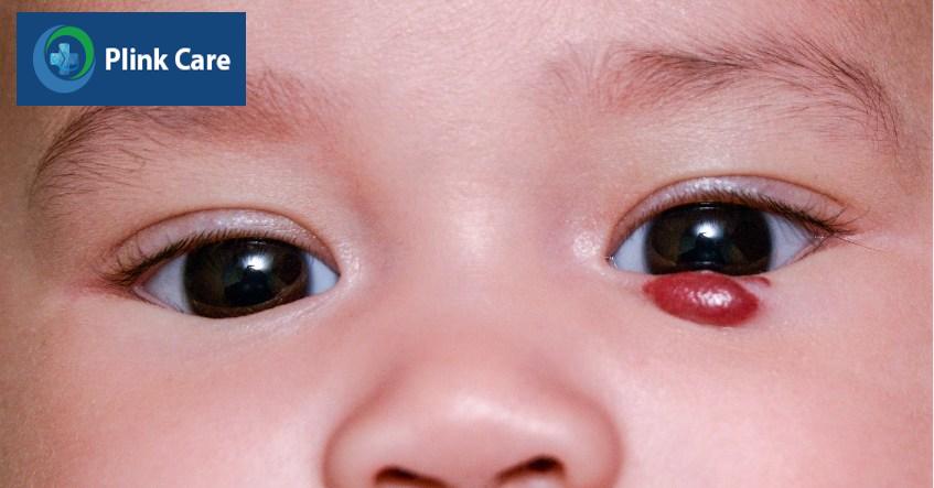 Phẫu thuật bướu máu được chỉ định
