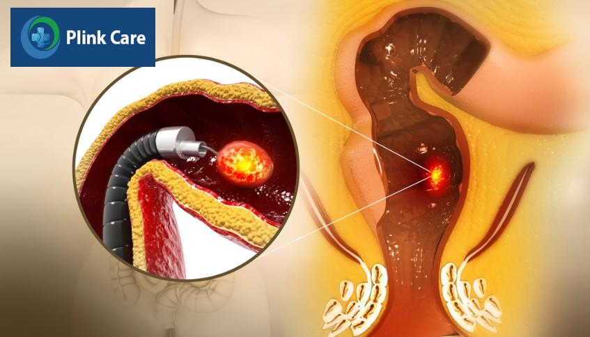 phẫu thuật nội soi để loại bỏ khối ung thư trực tràng