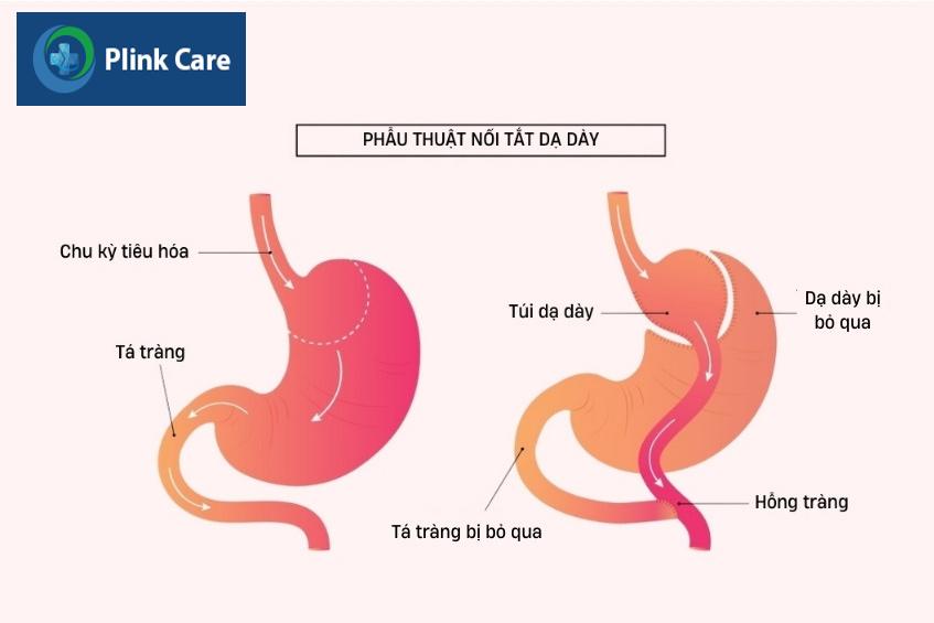 phẫu thuật nối tắt dạ dày