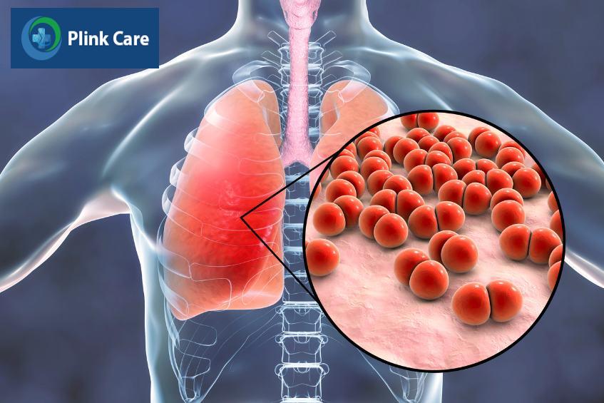 Phế cầu là nguyên nhân hàng đầu gây viêm phổi nói chung ở trẻ