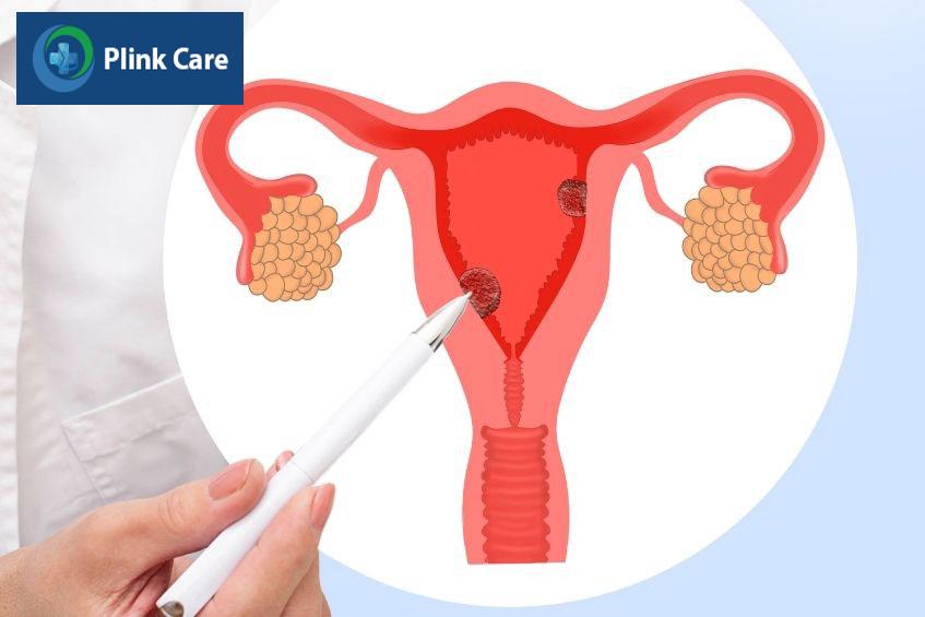 polyp tử cung gây tiết dịch màu nâu ở âm đạo