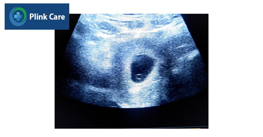 Siêu âm thai tuần thứ 5 giúp xác định túi thai trong tử cung người mẹ
