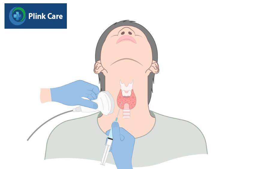 sinh thiết kim nhỏ chẩn đoán ung thư vòm họng