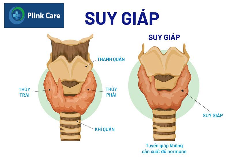 suy giáp là tình trạng tuyến giảm không sản sinh đủ hormone
