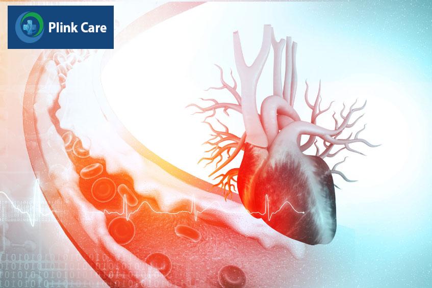 Vị trí tắc nghẽn ở động mạch vành có thể dẫn đến bệnh động mạch vành