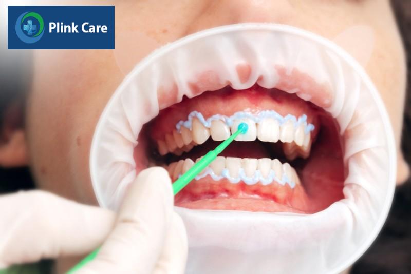 Các phương pháp tẩy trắng răng